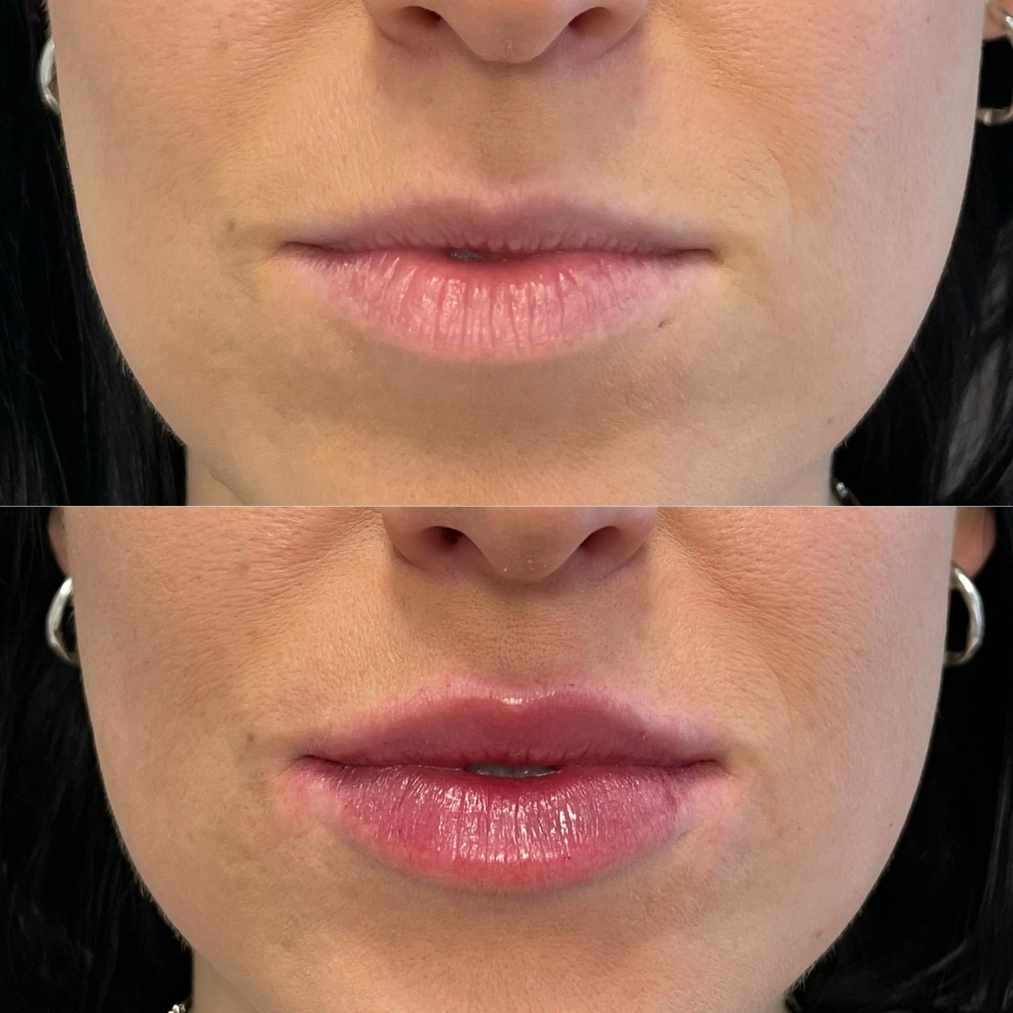 Lip Fillers London – Natural Lip Enhancement & Lip Augmentation
