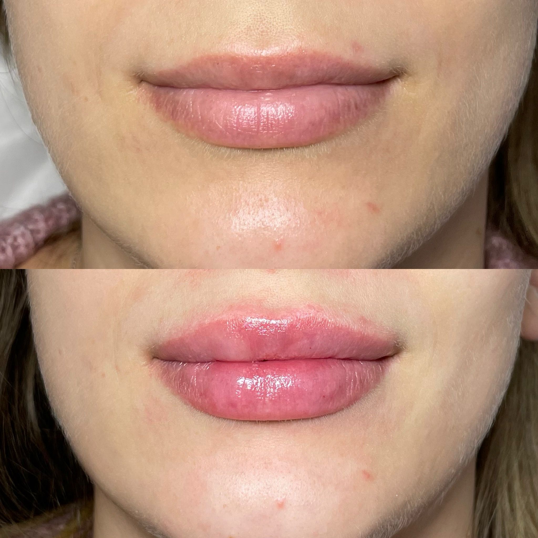 Lip Fillers London - Natural Lip Enhancement & Lip Augmentation